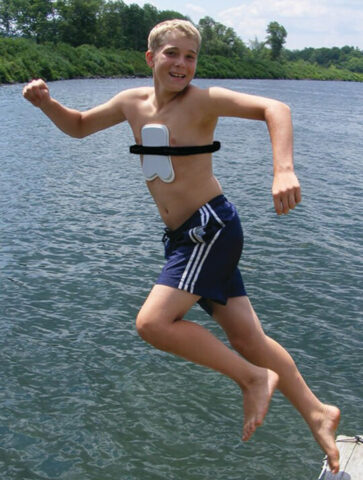 pectus brace